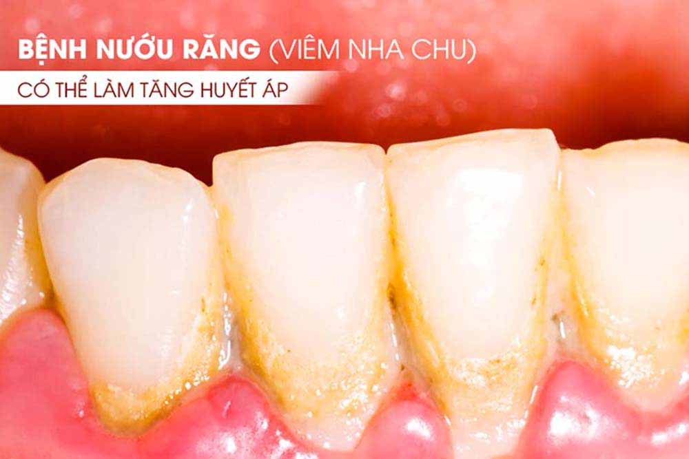 Bệnh nướu răng (viêm nha chu) có thể làm tăng huyết áp ?