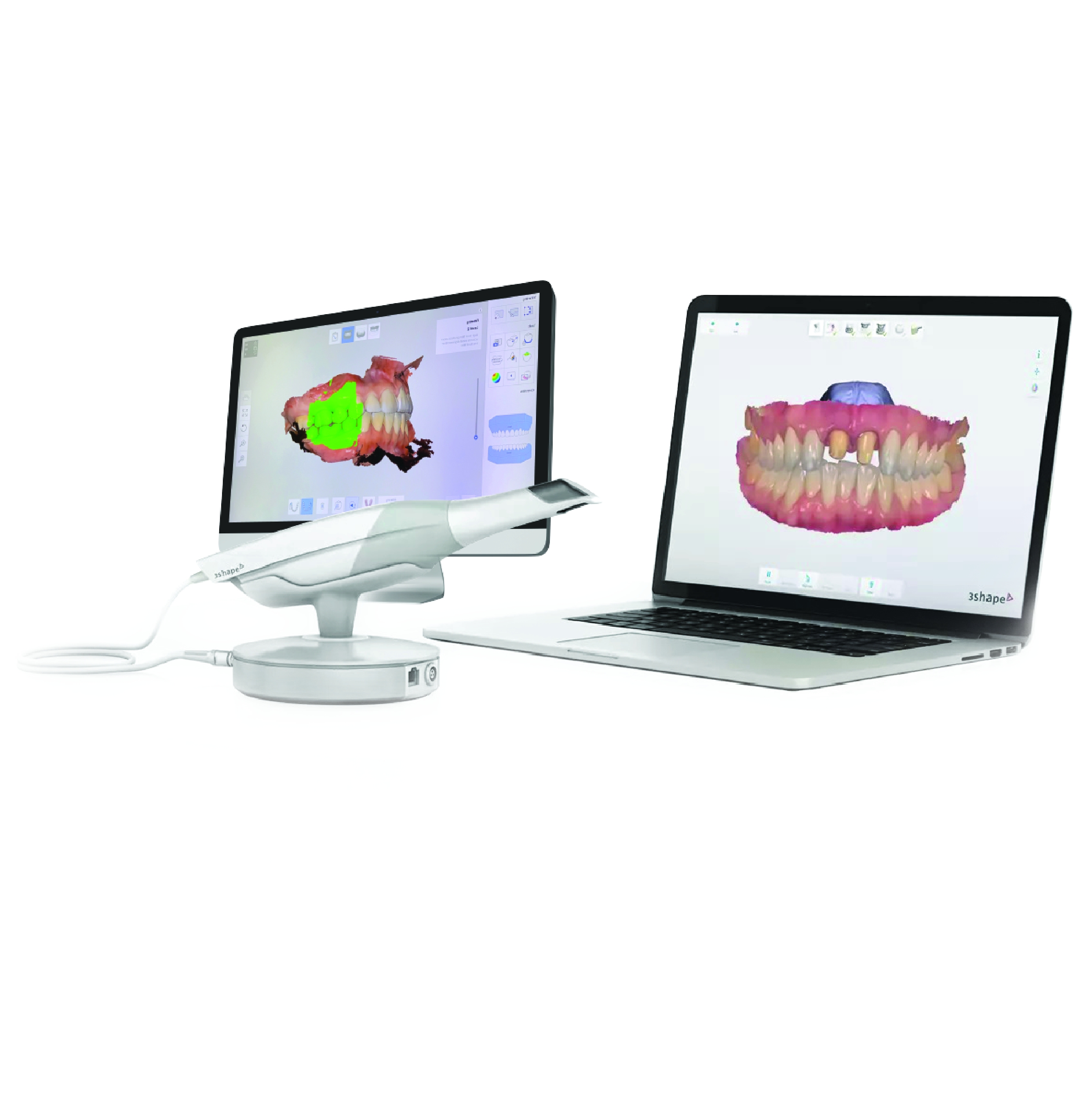 Scan trên miệng + in mẫu hàm 3D