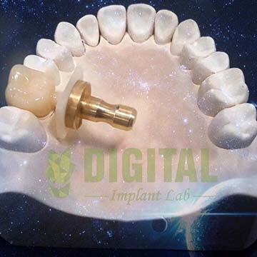 Phục hình 4H theo công nghệ 3D